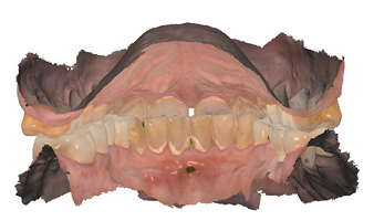 Post op digital scan lingual view.