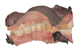 Post op digital scan left occlusion view.