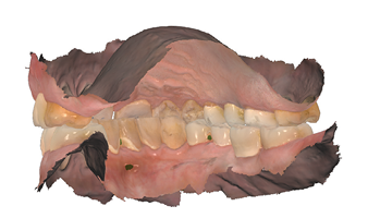 Post op digital scan occlusion right view.