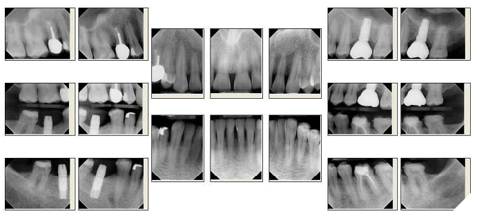 Full mouth radiographs.