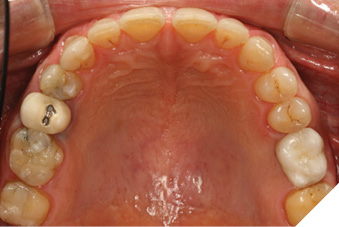 Pre op maxillary occlusal view.