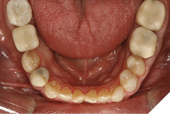 Pre op mandibular arch view.