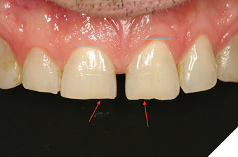 Pre op close up view maxillary central incisors