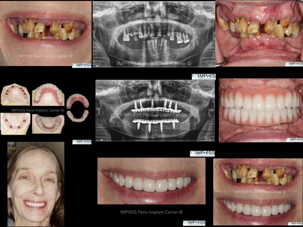 Full Mouth Rehabilitation of Terminal Dentition with Fixed Implant ...