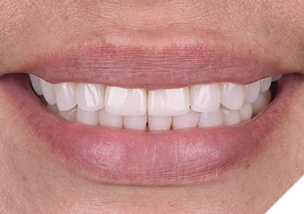 Prep-op smile view: ceramic veneers on maxillary central incisors are not esthetic in color and shape.