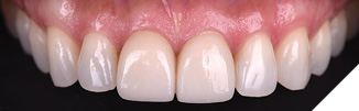 The patient was dissatisfied with the appearance of her veneers. These had been cemented recently and required replacement for esthetic reasons.