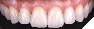 The newly cemented veneers have better integration with the natural dentition.
