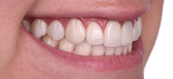 Prep-op smile views of ceramic veneers from 2nd bicuspid to 2nd bicuspid and crown on left central where gingival inflammation is evident.