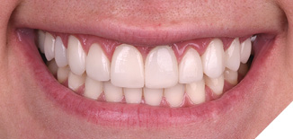 Prep-op smile views of ceramic veneers from 2nd bicuspid to 2nd bicuspid and crown on left central where gingival inflammation is evident.