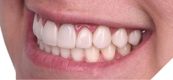 Prep-op smile views of ceramic veneers from 2nd bicuspid to 2nd bicuspid and crown on left central where gingival inflammation is evident.