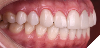 Intraoral pre-op photos show the difference in gingival health between the upper veneers and the lower natural dentition.