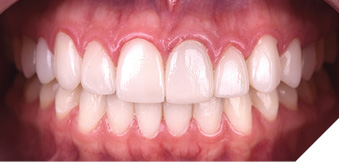 Intraoral pre-op photos show the difference in gingival health between the upper veneers and the lower natural dentition.