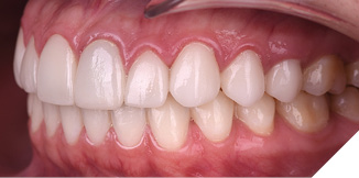 Intraoral pre-op photos show the difference in gingival health between the upper veneers and the lower natural dentition.