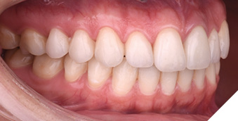 Resolution of the case after placement of 9 new veneers and one crown.
