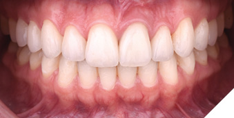 Resolution of the case after placement of 9 new veneers and one crown.
