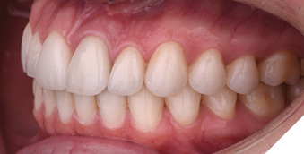 Resolution of the case after placement of 9 new veneers and one crown.