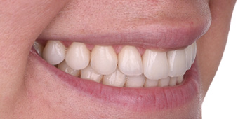 Post-op
smile views. Not only was the gingival health restored but the underlying tooth structure
was preserved as a result of using laser technology to remove the original restorations.