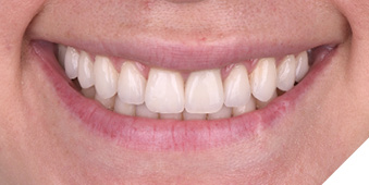 Post-op
smile views. Not only was the gingival health restored but the underlying tooth structure
was preserved as a result of using laser technology to remove the original restorations.