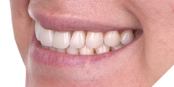 Post-op
smile views. Not only was the gingival health restored but the underlying tooth structure
was preserved as a result of using laser technology to remove the original restorations.