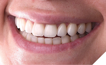 Post-op
smile views. Not only was the gingival health restored but the underlying tooth structure
was preserved as a result of using laser technology to remove the original restorations.