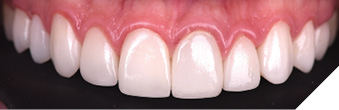 A healthy and esthetic smile after replacing failing veneers using laser technology.