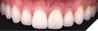 A healthy and esthetic smile after replacing failing veneers using laser technology.