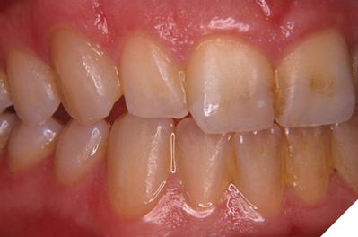 Clinical case (A) Before and (B) After.