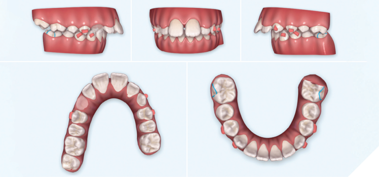 Ma Phase Invisalign Class II orthodontic treatment of a growing patient using Invisalign ...