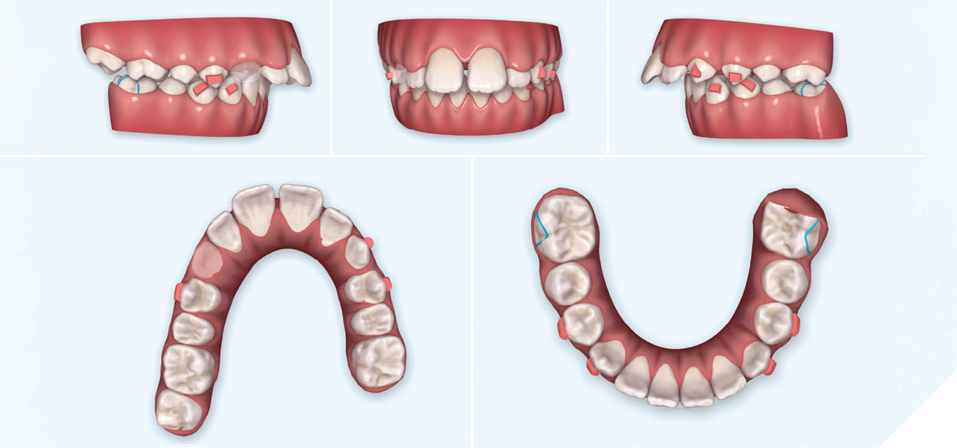 Class II orthodontic treatment of a growing patient using Invisalign ...