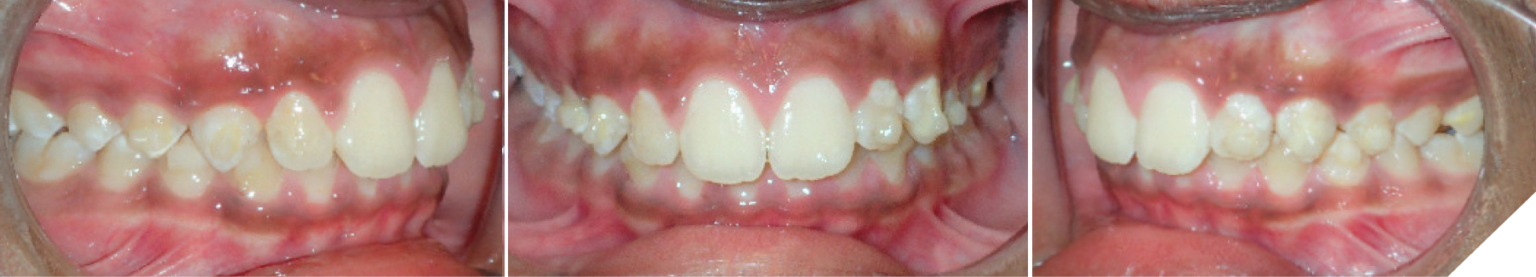 Ma Phase Invisalign Class II orthodontic treatment of a growing patient using Invisalign ...