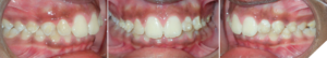 Class II orthodontic treatment of a growing patient using Invisalign ...