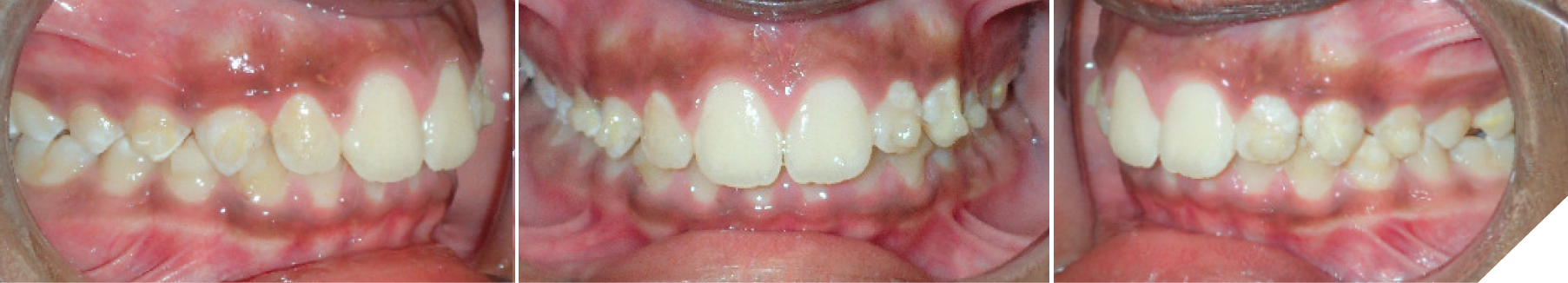 Ma Phase Invisalign Class II orthodontic treatment of a growing patient using Invisalign ...