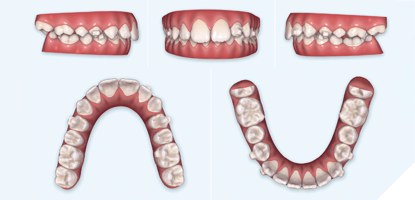 Ma Phase Invisalign Class II orthodontic treatment of a growing patient using Invisalign ...