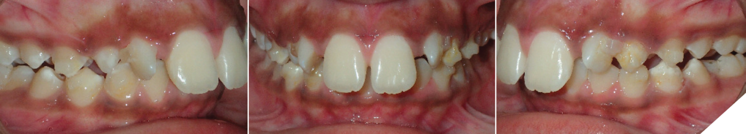Class II orthodontic treatment of a growing patient using Invisalign ...