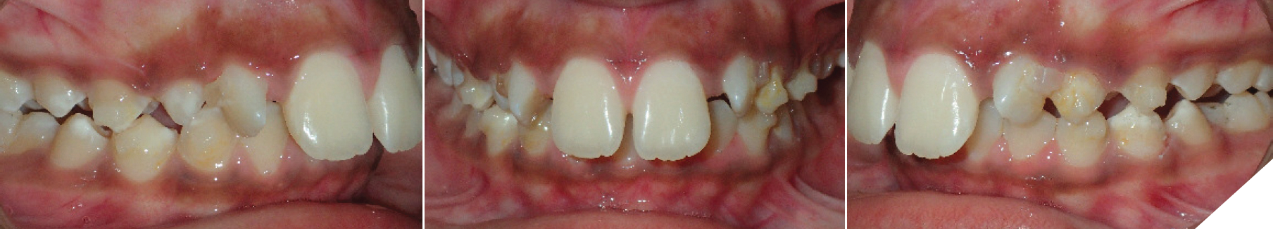 Ma Phase Invisalign Class II orthodontic treatment of a growing patient using Invisalign ...