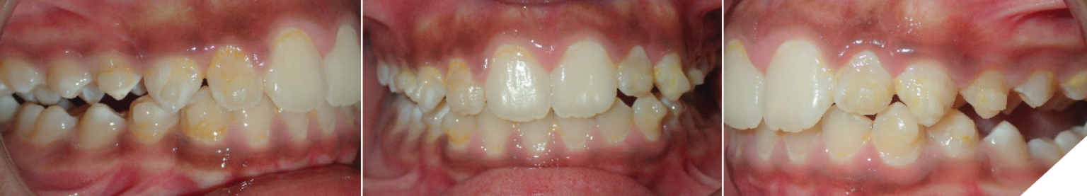 Class II orthodontic treatment of a growing patient using Invisalign ...