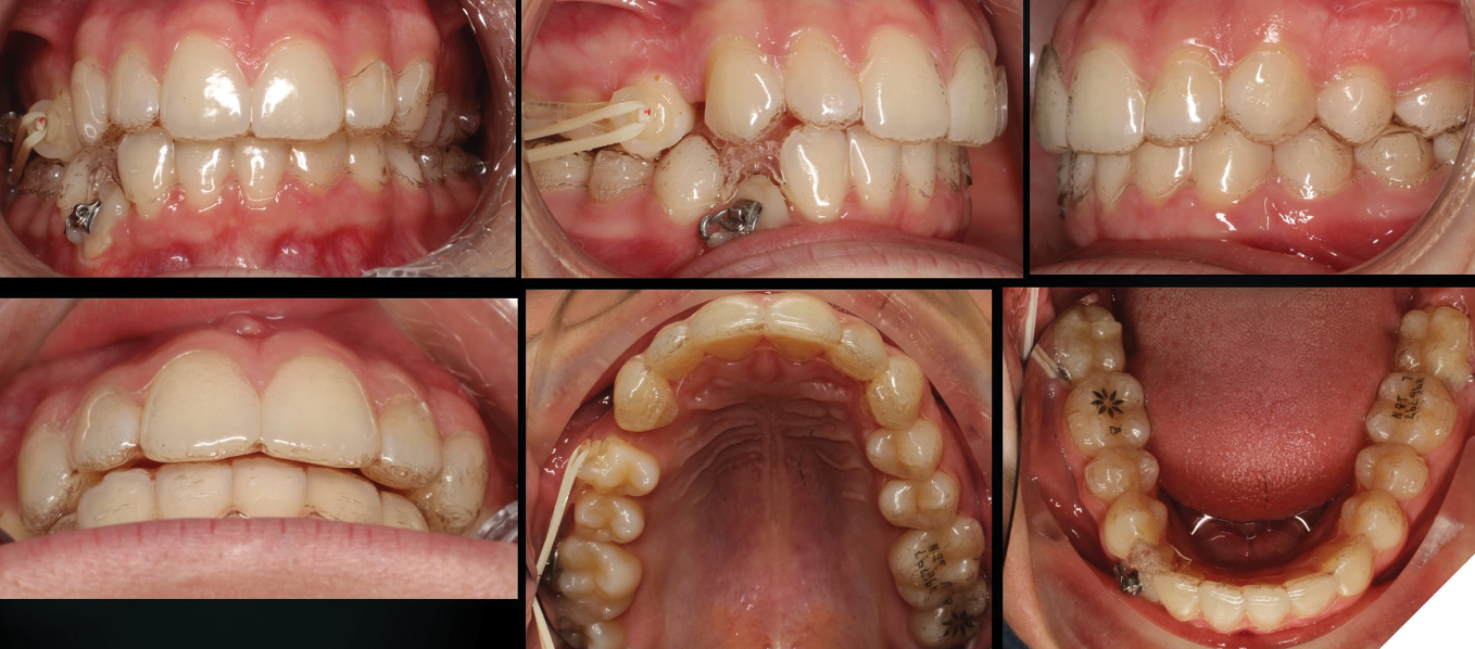 Treatment of a class II subdivision and impacted canine with Clear ...