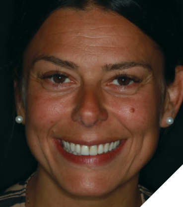  A healthy 38-year-old female presented to the practice for a smile consultation. Her chief concerns were the constant chipping of anterior composite veneer restorations on maxillary teeth #6-#11 as well as the shade and black triangle between teeth #8 and #9. 