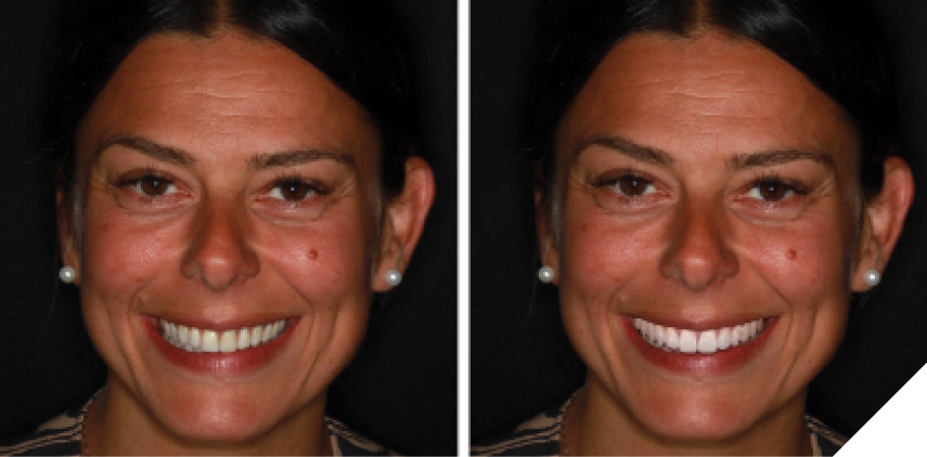 Using smile design software and photos of the patient, a simulation of the proposed treatment outcome was shown to the patient for acceptance of the treatment plan.