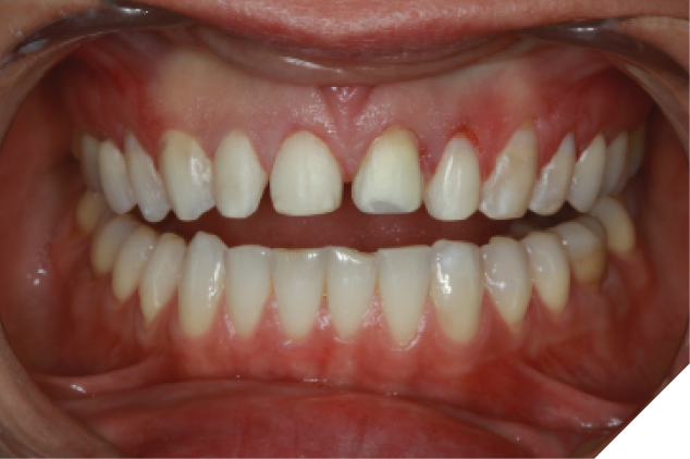  The patient’s six anterior teeth were prepped and the preparations polished. 