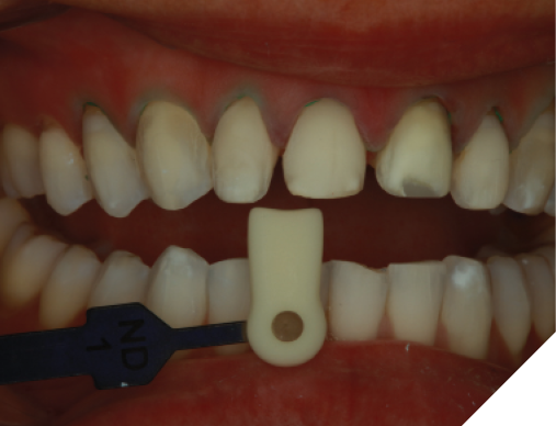 Polorized photos were taken of the prepared teeth with shade tab for communication with the laboratory for shade matching purposes. 