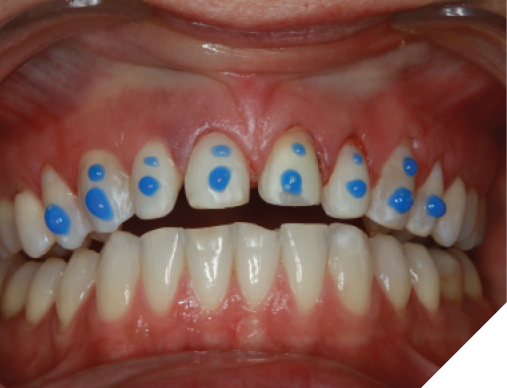  The preparations were spot etched with 35% phosphoric acid gel.