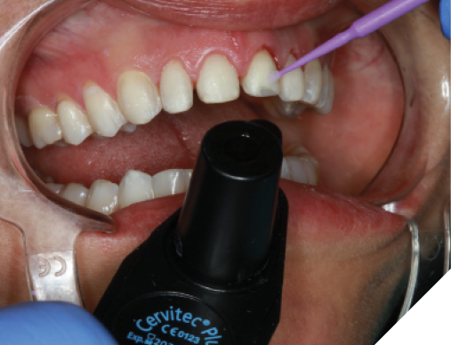 The spot-etched preparations were coated with Cervitec Plus antibacterial varnish.