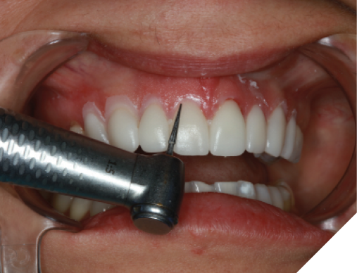 Excess flash was removed around each provisional using a finishing carbide. 