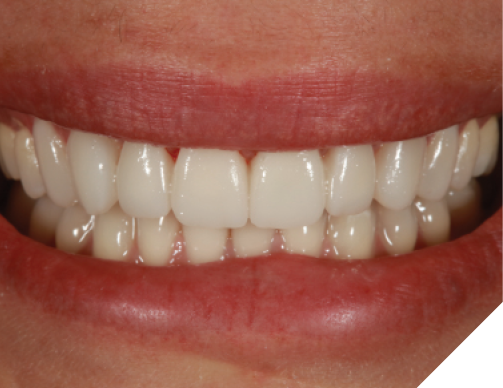  After checking occlusion, the patient was sent home to “test-drive” her provisionals and given home care instructions for maintaining gingival health around the provisionals.