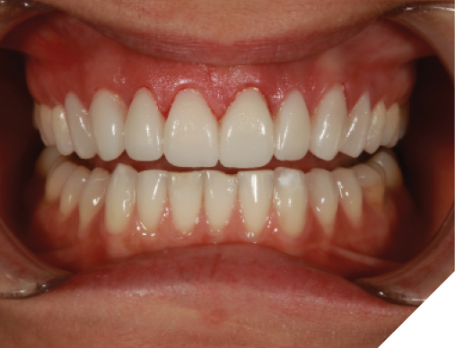  After checking occlusion, the patient was sent home to “test-drive” her provisionals and given home care instructions for maintaining gingival health around the provisionals.