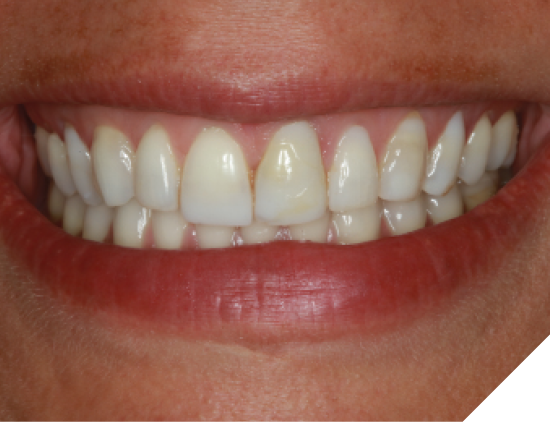 A volley ball accident at age 12 fractured her central incisors, leading to root canal therapy in her teens and composite Class IV restorations. In her early 30s composite resin veneers were placed on her maxillary anterior teeth #6-#11 to improve her smile.