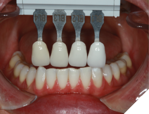  Shade evaluation of her in-office whitened lower anterior teeth would aid in blending the shade of with maxillary veneers with her natural lower anterior teeth.