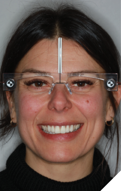 A photo of the provisionalized patient with Kois facial reference glasses captured the patient’s dentofacial esthetic data for the laboratory. 22. Final shade selection was made with Chromoscop shade tabs photographed with polarized filter. 