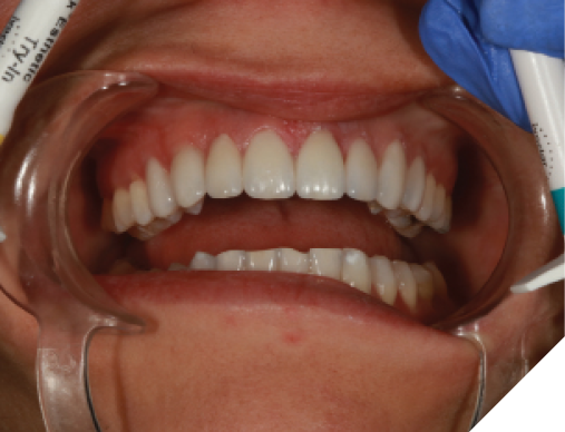 Try-in pastes were used to determined final cement shade for best esthetic results. 